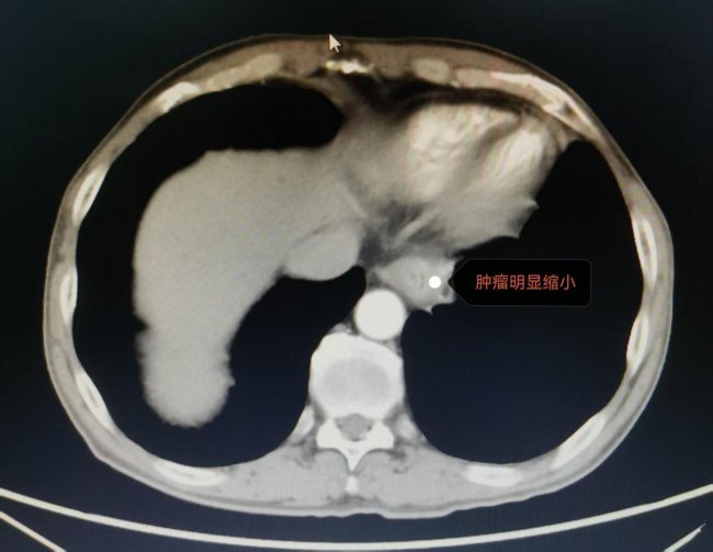 从“无法手术”到成功根治 河北一洲肿瘤医院完成高难度食管胃结合部肿瘤切除术